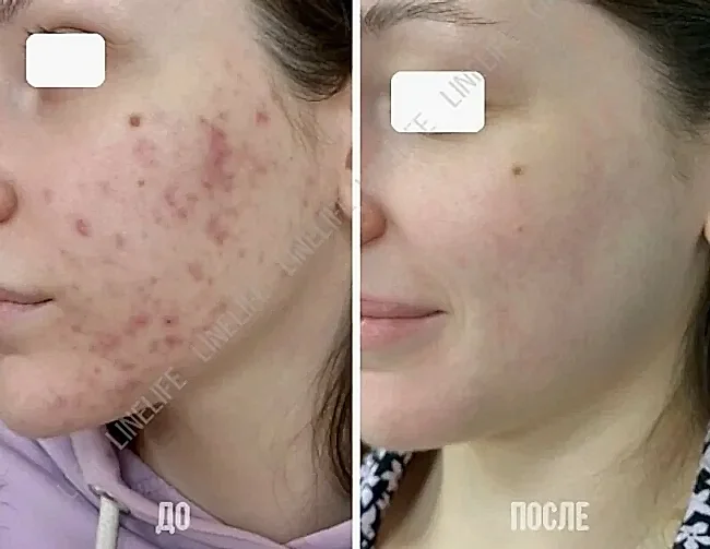 lechenie_akne.jpg