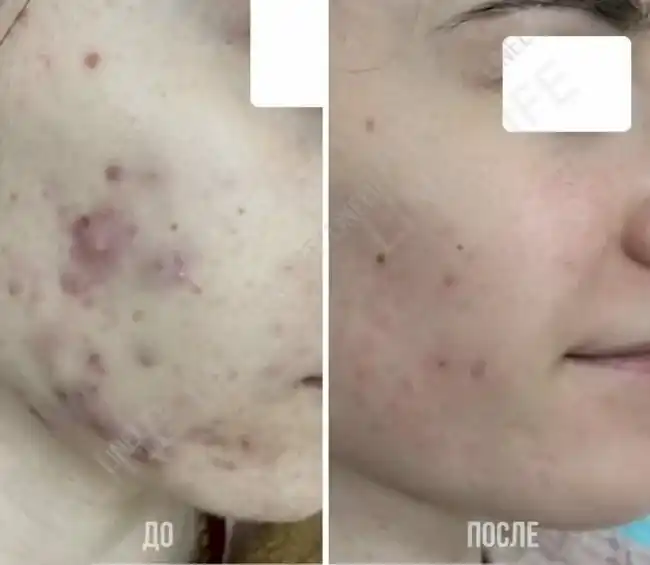 ugrevaya_bolezn_akne.jpg